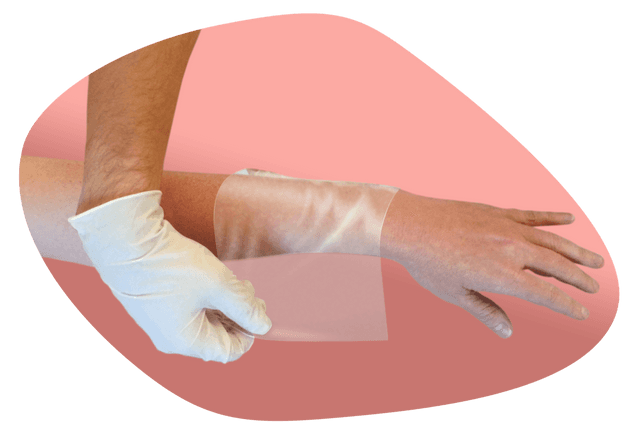 BIOBRANE biyosentetik yara örtüsünün ön kola uygulanmasını gösteren resmî görsel